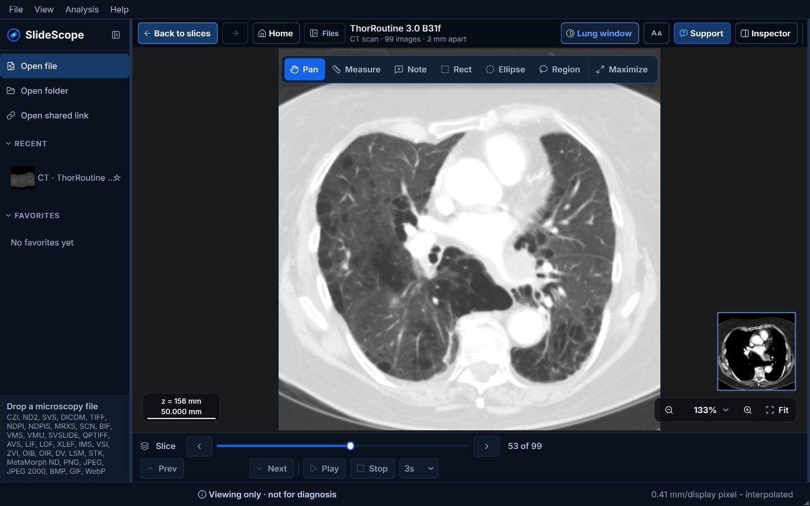 SlideScope showing a chest CT in the lung window