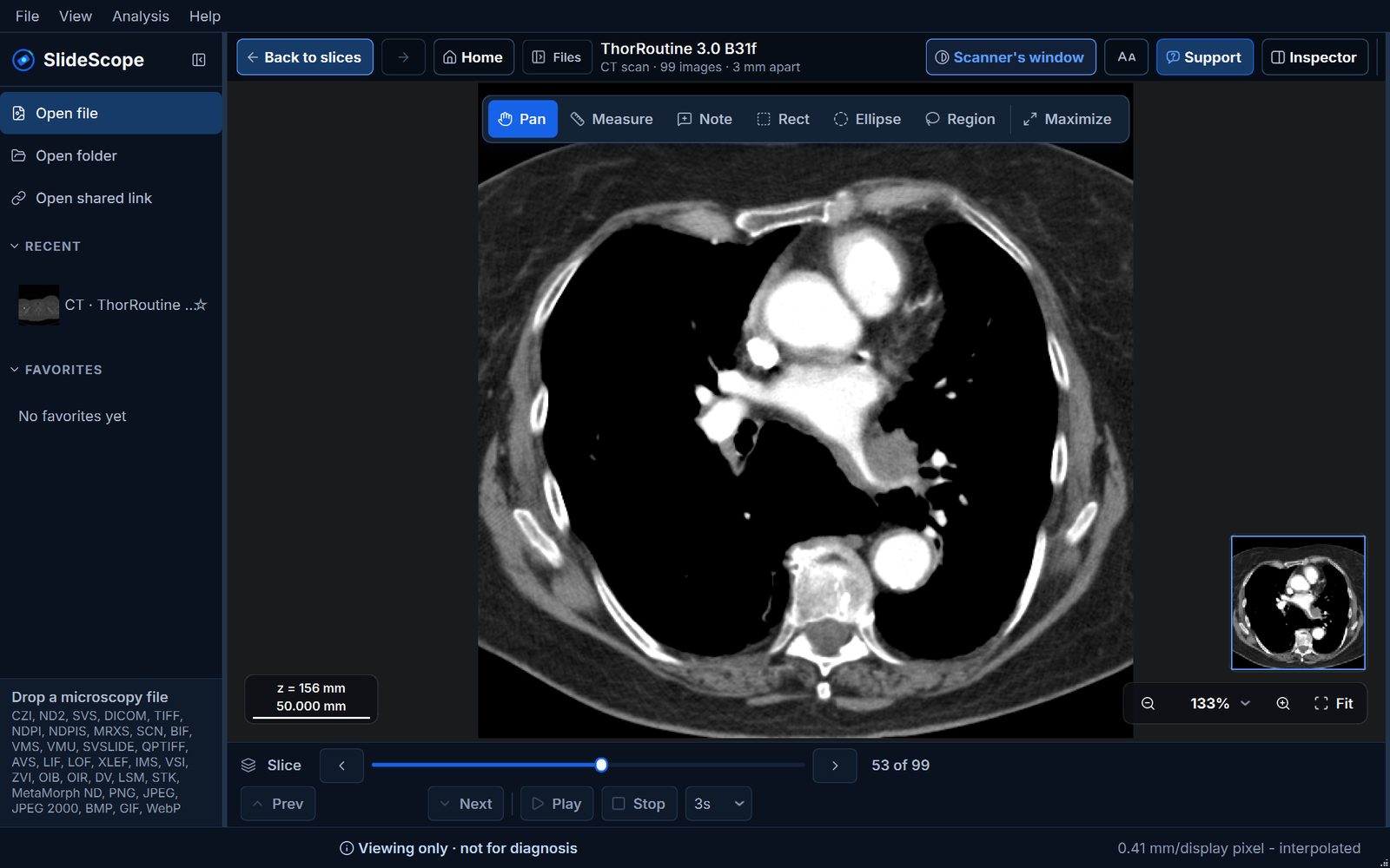 SlideScope showing a 99-slice chest CT from a hospital disc in its soft-tissue window, with the Slice navigator and the Viewing only, not for diagnosis notice