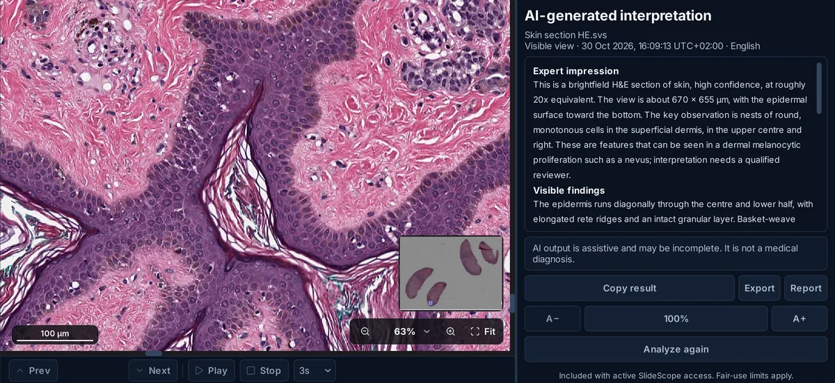 SlideScope showing an H&E skin section at 20x next to the AI Analysis panel, which reads: brightfield H&E section of skin, nests of round monotonous cells in the superficial dermis, interpretation needs a qualified reviewer.
